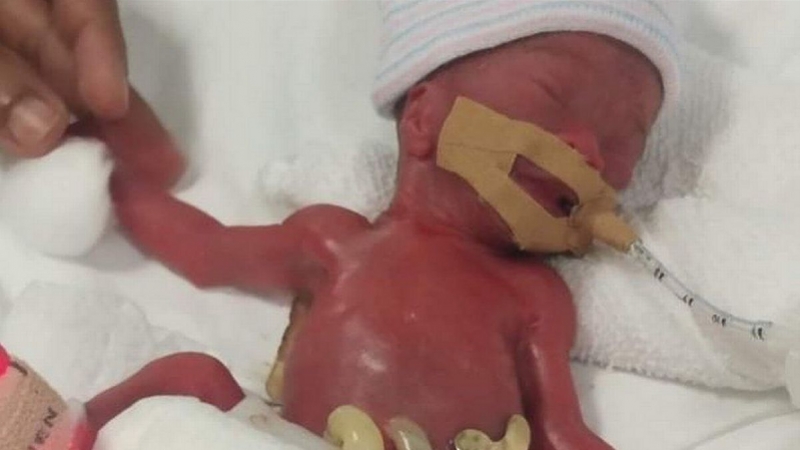 “世界最小婴儿”出生仅有一个苹果重，治疗13个月奇迹存活